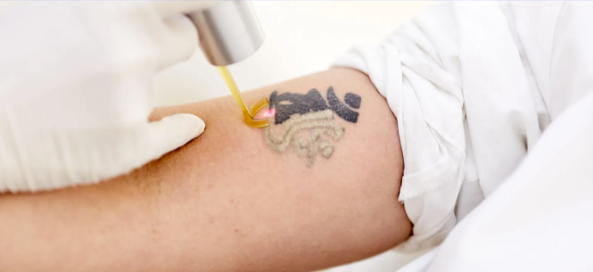 Pico Laser Tatoeage Verwijderen